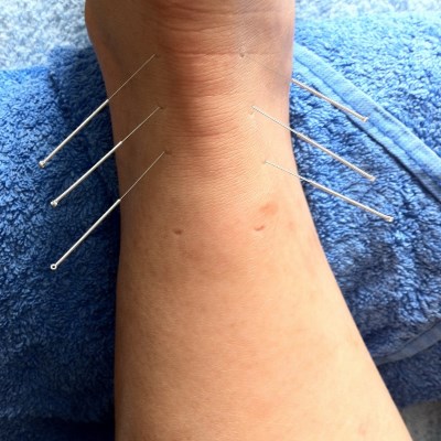 image of patient being treated with acupuncture